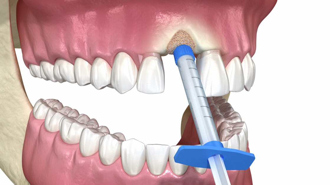 Bone Grafting