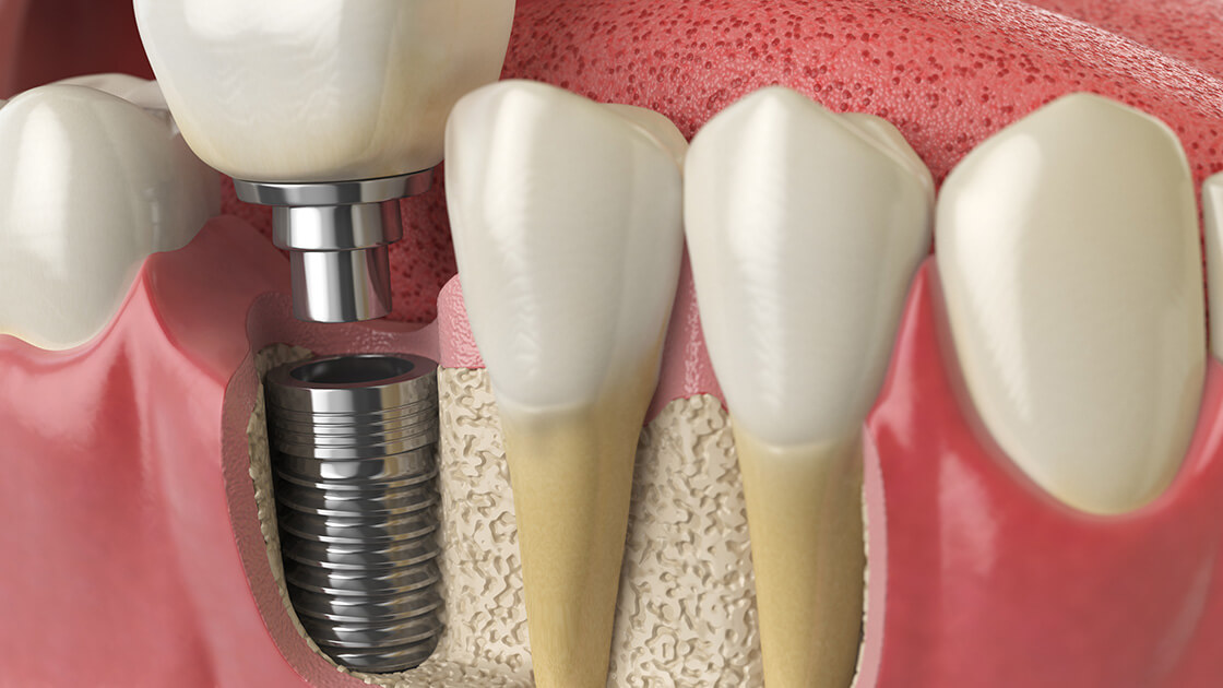 Wisdom Tooth Removal (3rd Molars)