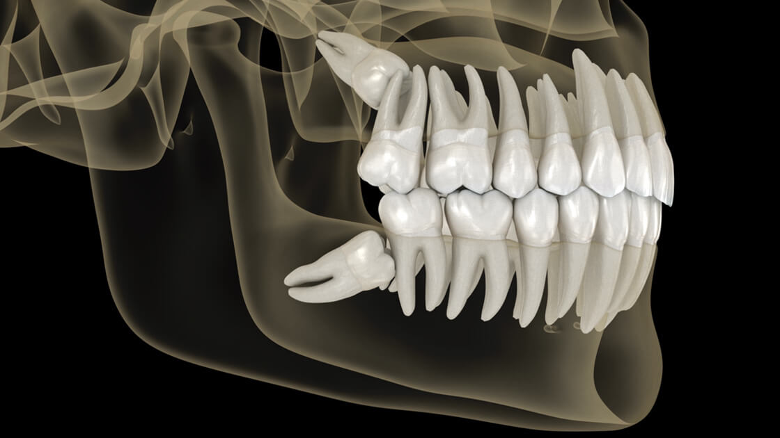 Impacted Tooth & Tooth Exposure